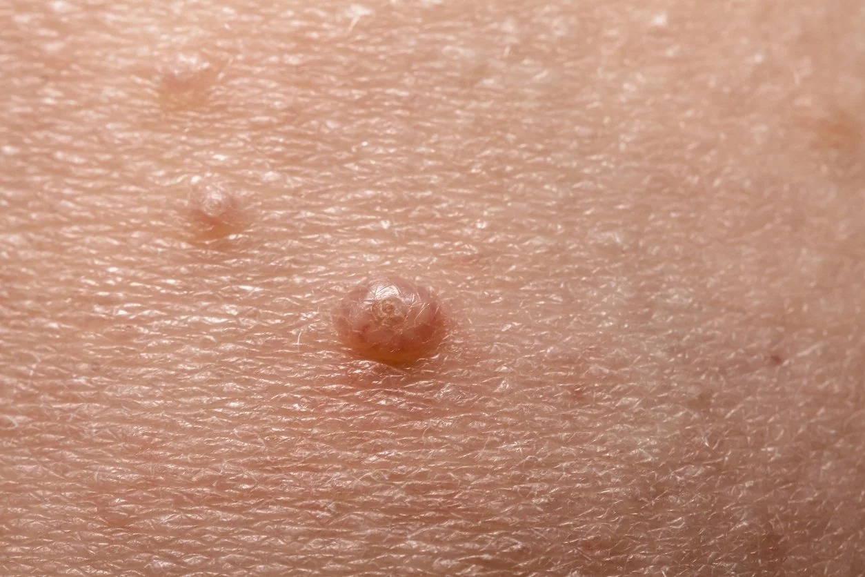 Molluscum Dr. Victoria Moss Dermatology Colorado Springs