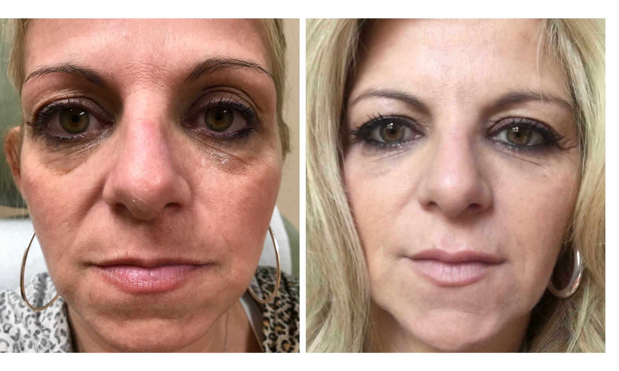 Before and after of patient with full face rejuvenation using hyaluronic acid dermal fillers performed by Dr. Victoria Moss, board certified dermatologist.