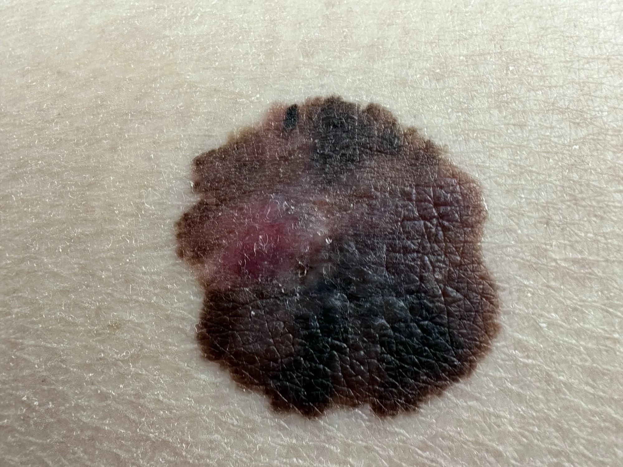 Melanoma Colorado Springs Aria Dermatology