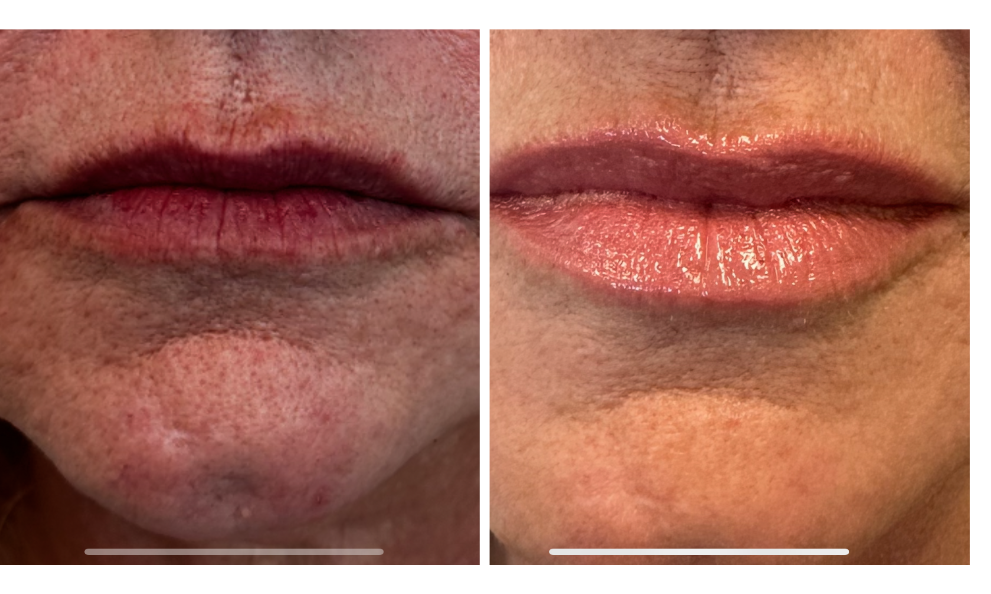 Before and after showing lip filler rejuvenation with natural results, performed by Dr. Victoria Moss, board certified dermatologist.