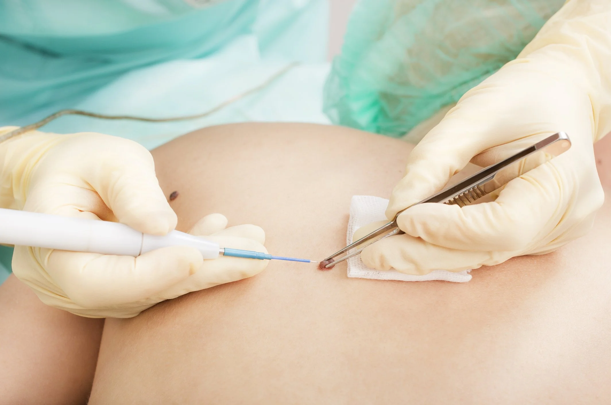 Dermatologist performing a simple outpatient procedure - removing a mole.
