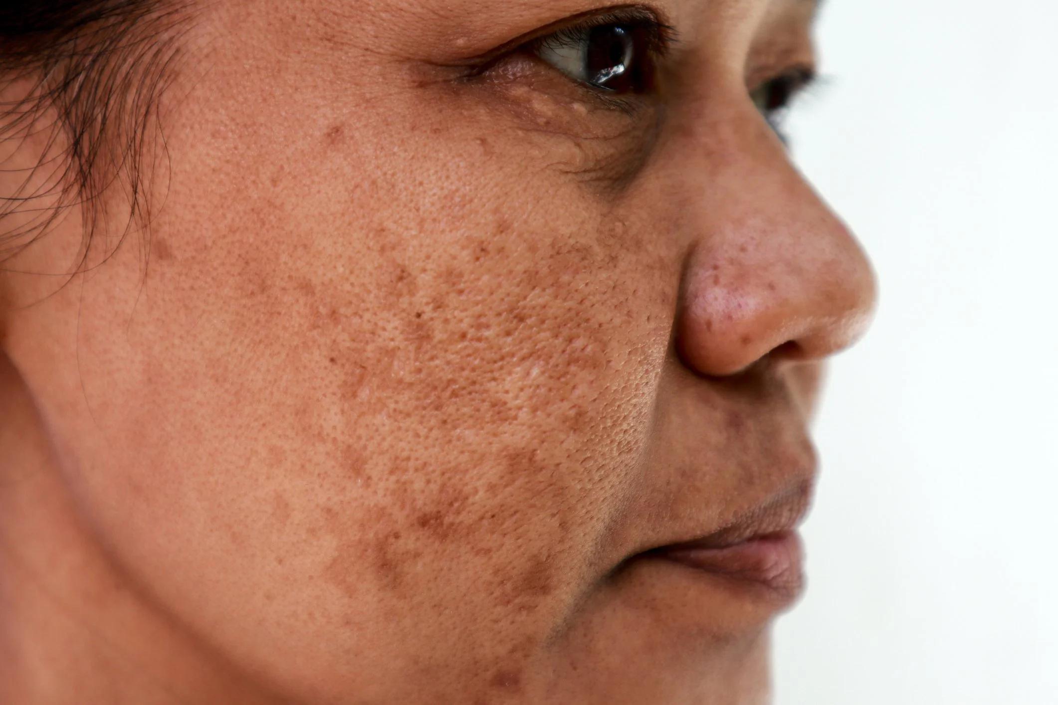 Melasma Aria Dermatology Colorado Springs