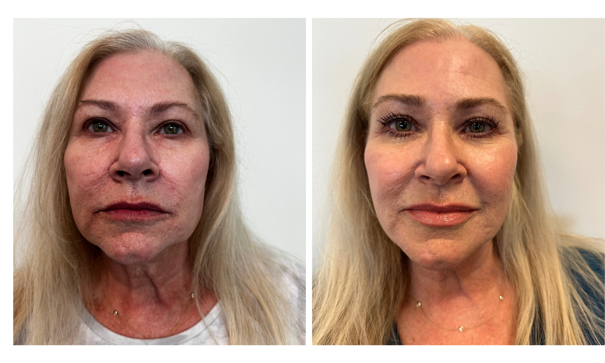 Before and after of patient with full face rejuvenation using hyaluronic acid dermal fillers, performed by Dr. Victoria Moss, board certified dermatologist.