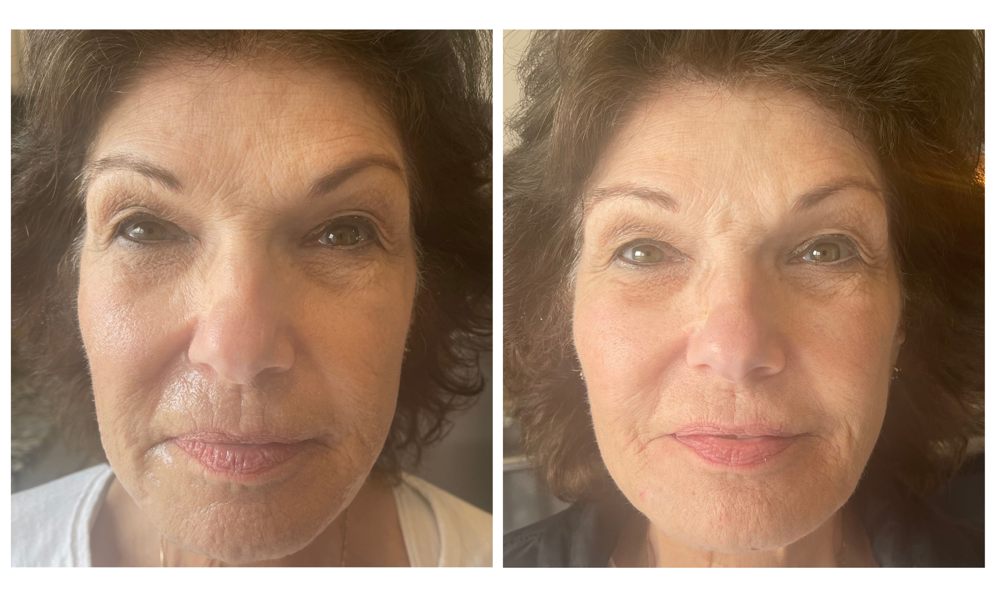 Before and after of dermal filler restoration for mid face, nasolabial folds, marionette lines, acne scars and lips with the Juvederm family of fillers, performed by Dr. Victoria Moss, board certified dermatologist.