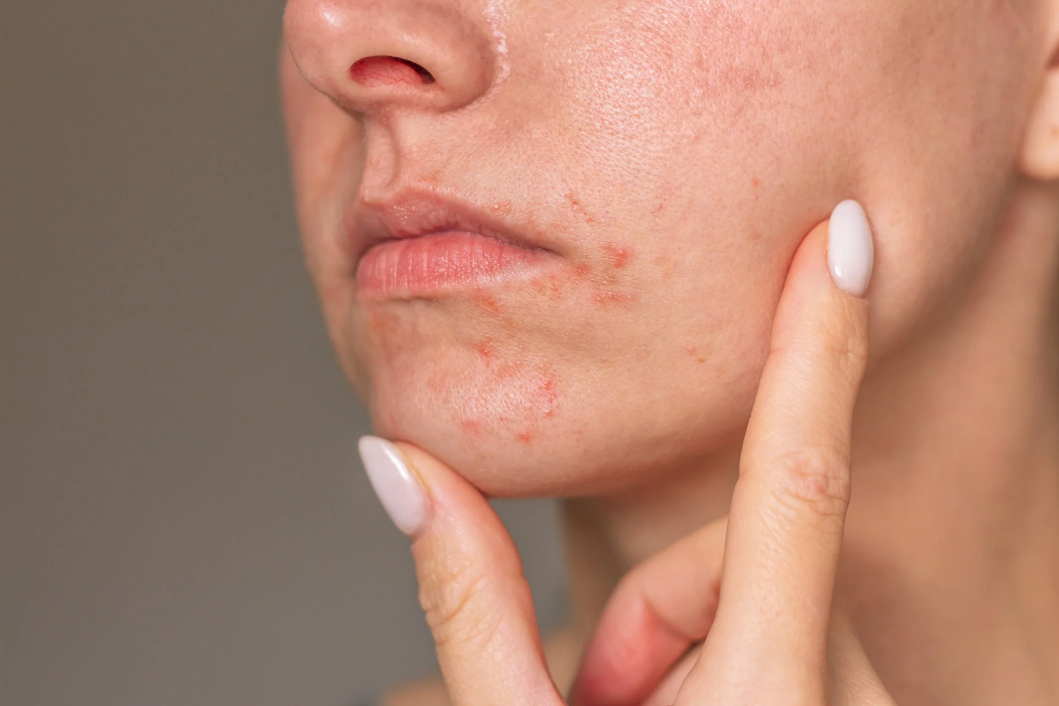 Perioral Dermatitis Colorado Springs