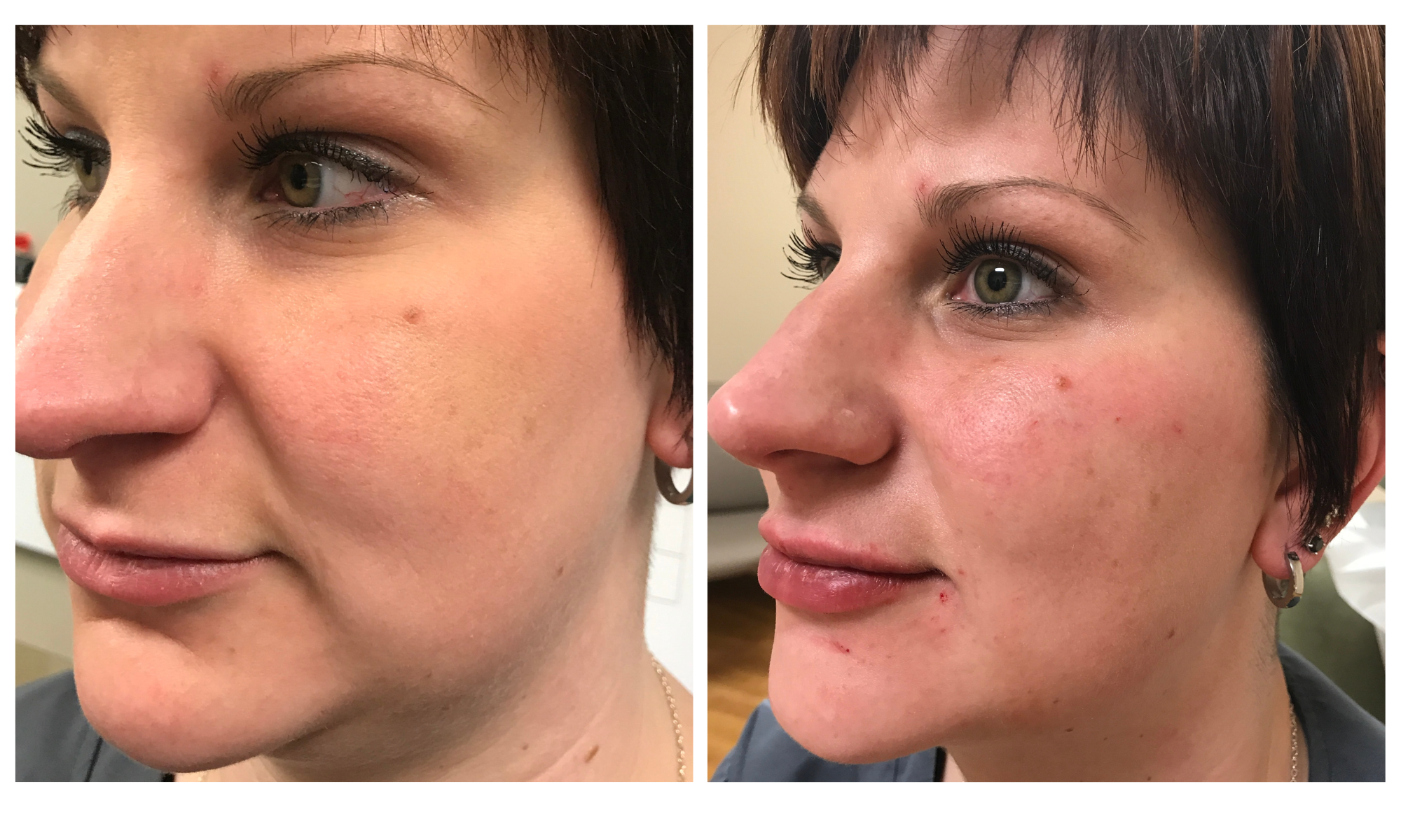 Before and after of full face hyaluronic acid dermal filler improving mid face, jowls, nasolabial folds, performed by Dr. Victoria Moss, board certified dermatologist.