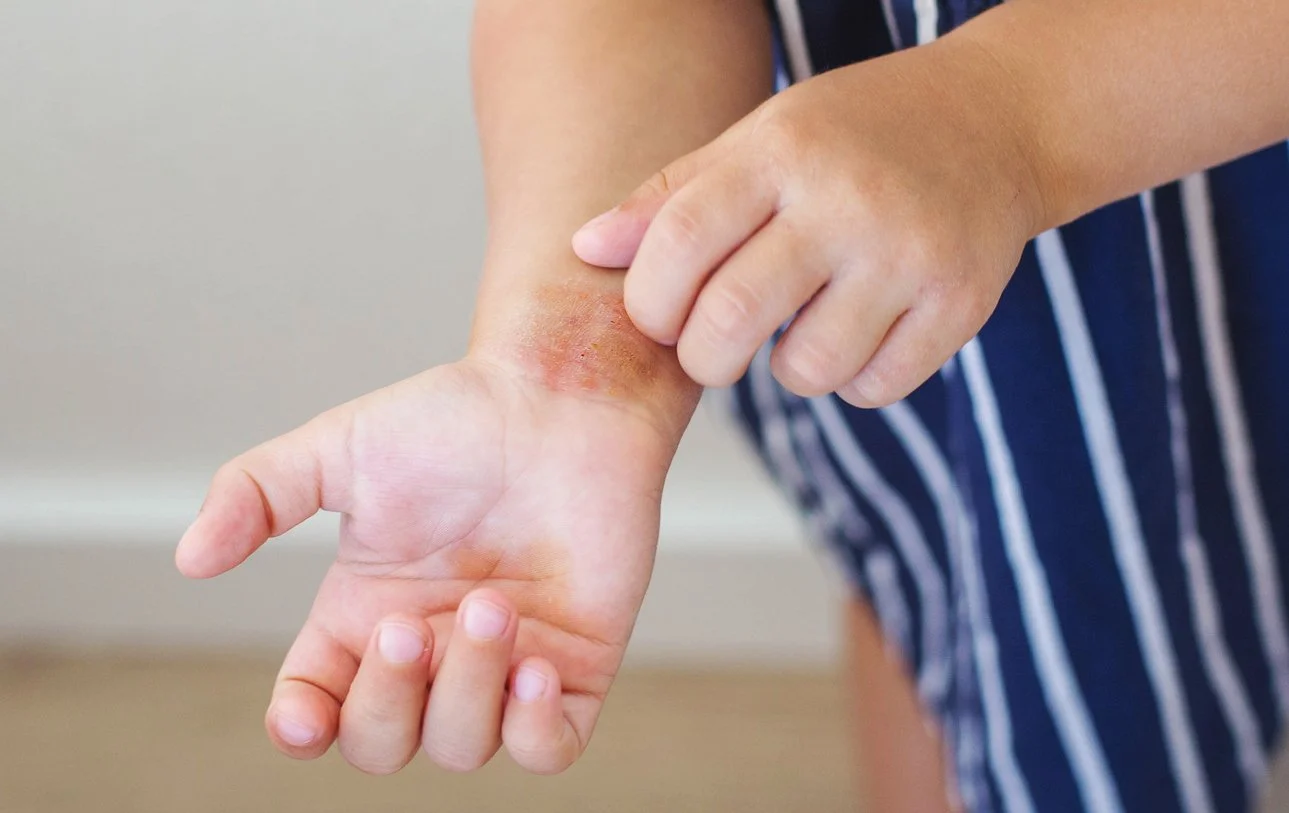 Eczema Colorado Springs Aria Dermatology