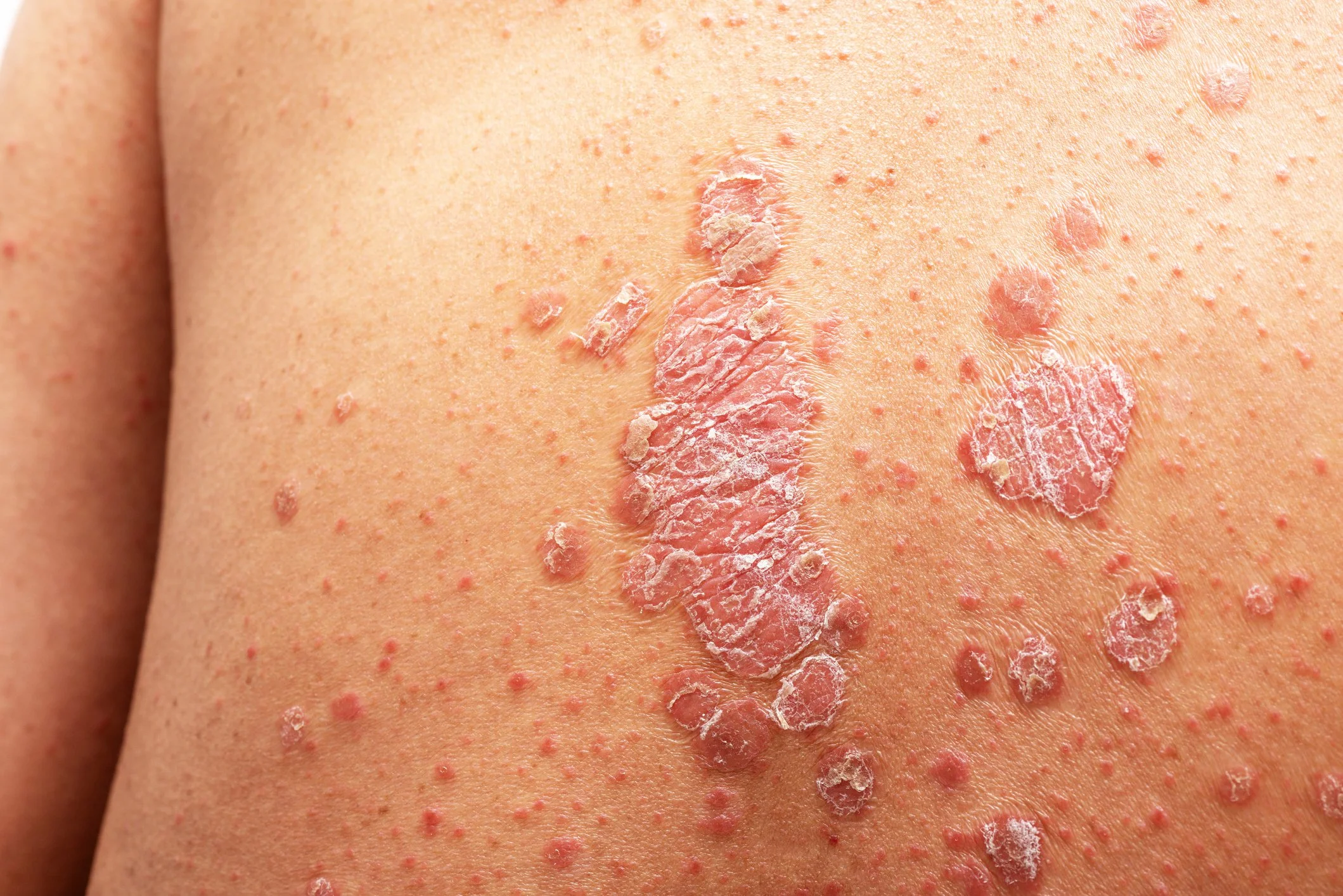 Psoriasis Colorado Springs Aria Dermatology