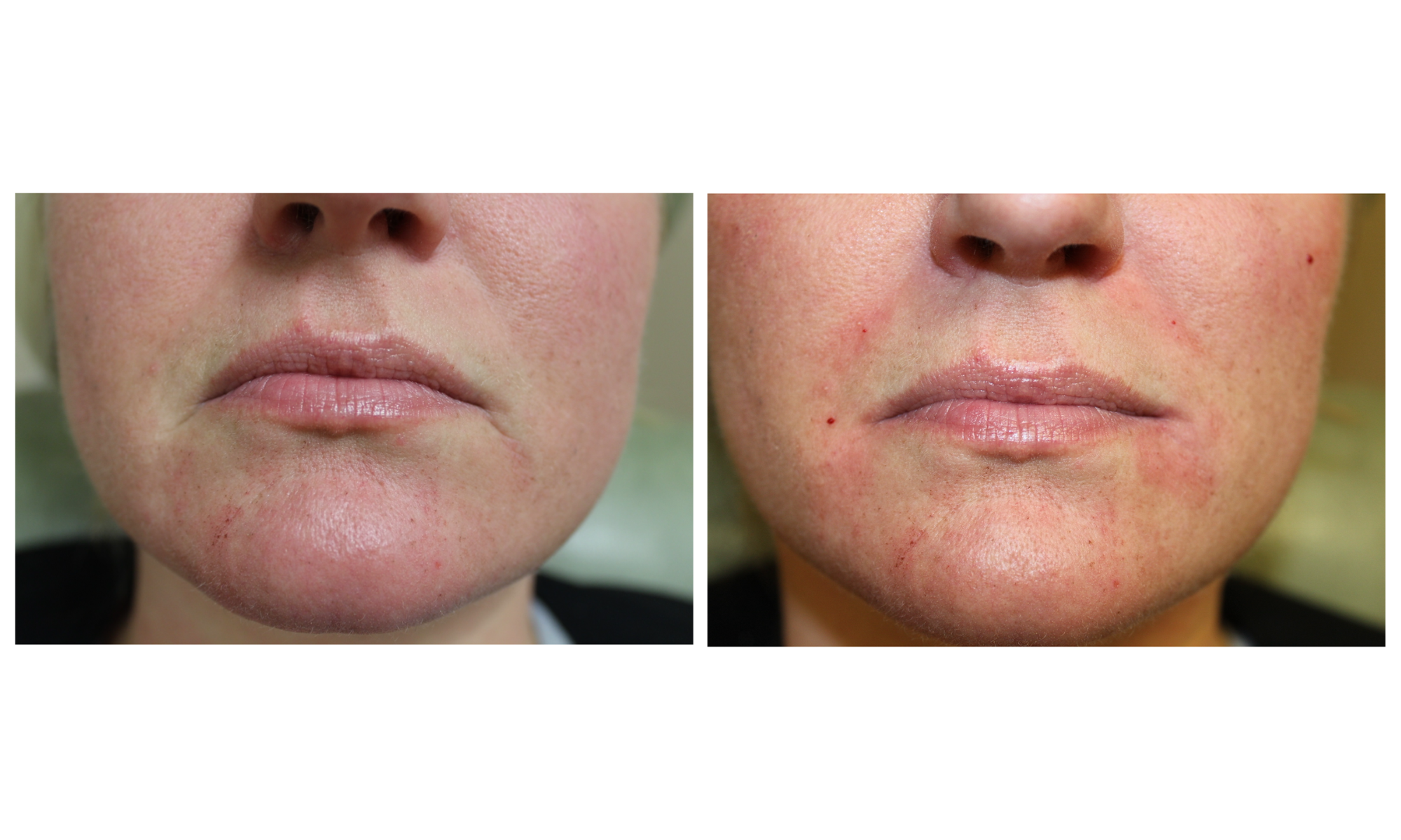 Before and after of dermal filler using Juvederm Ultra Plus for nasolabial folds, performed by Dr. Victoria Moss, board certified dermatologist.