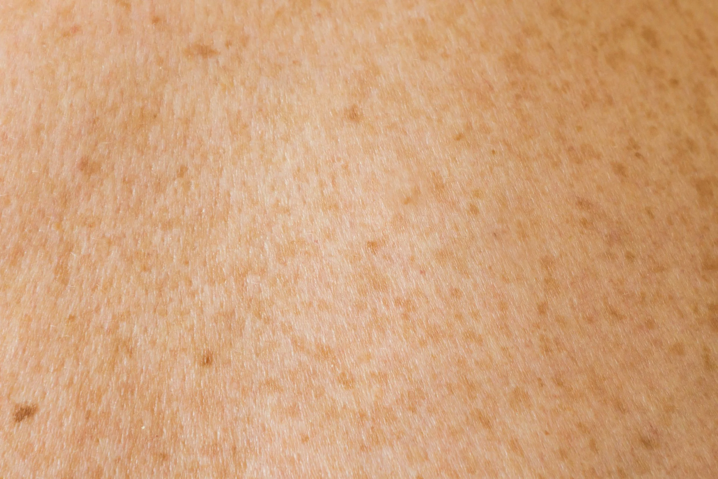 Hyperpigmentation Colorado Springs Dermatology 
