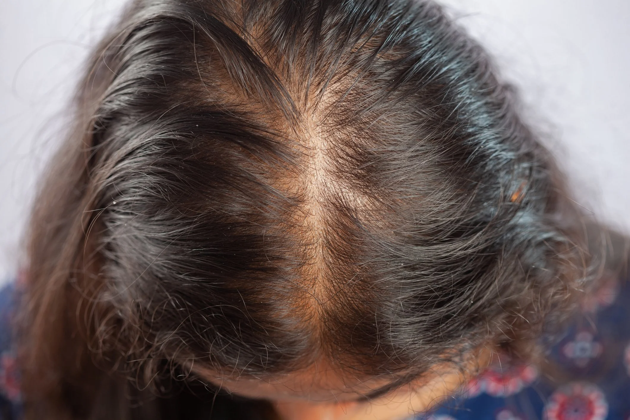 Alopecia Hair Loss Colorado Springs Aria Dermatology