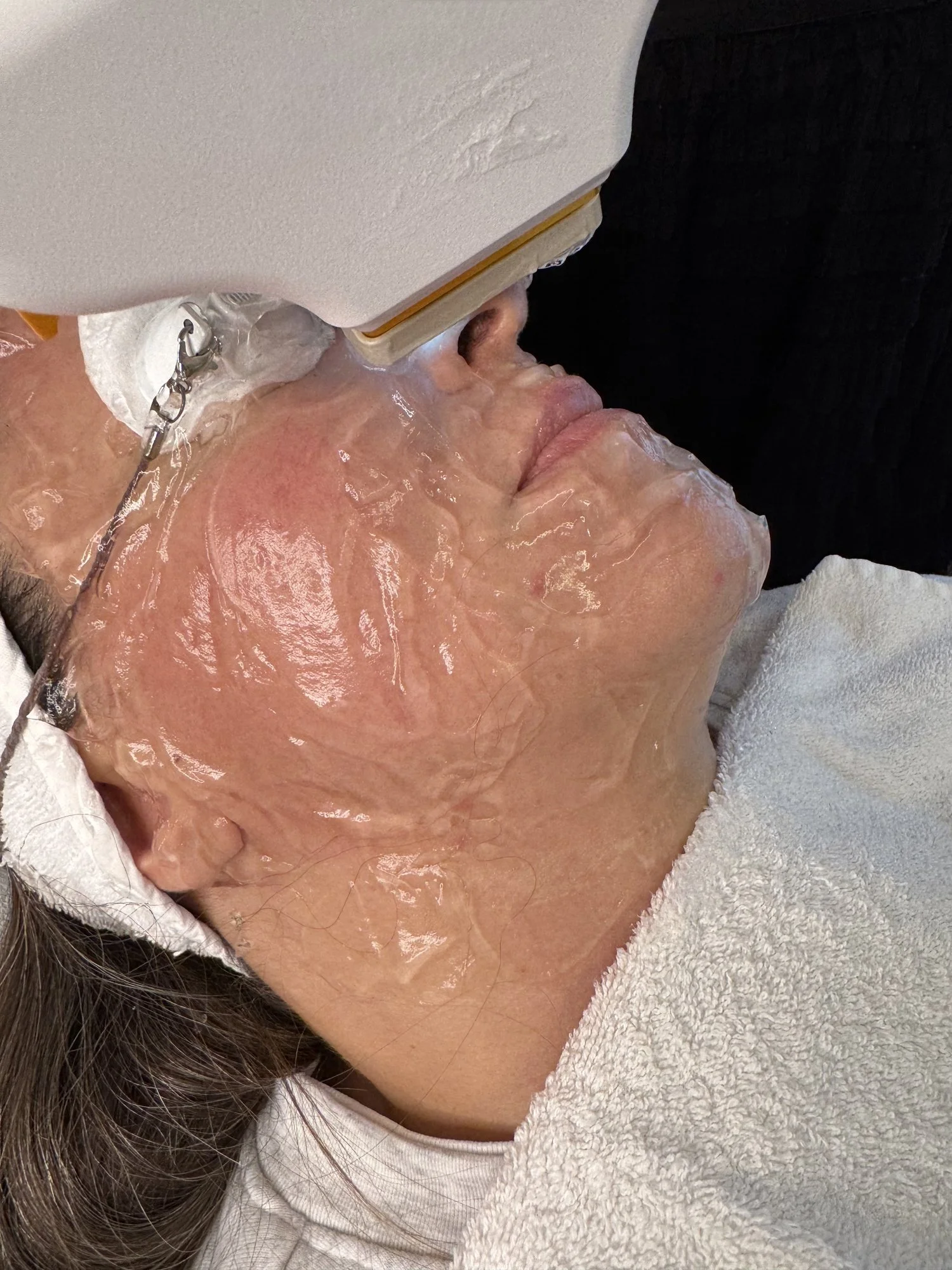 BBL Broadband Light Photofacial Victoria Moss Aria Dermatology Colorado Springs