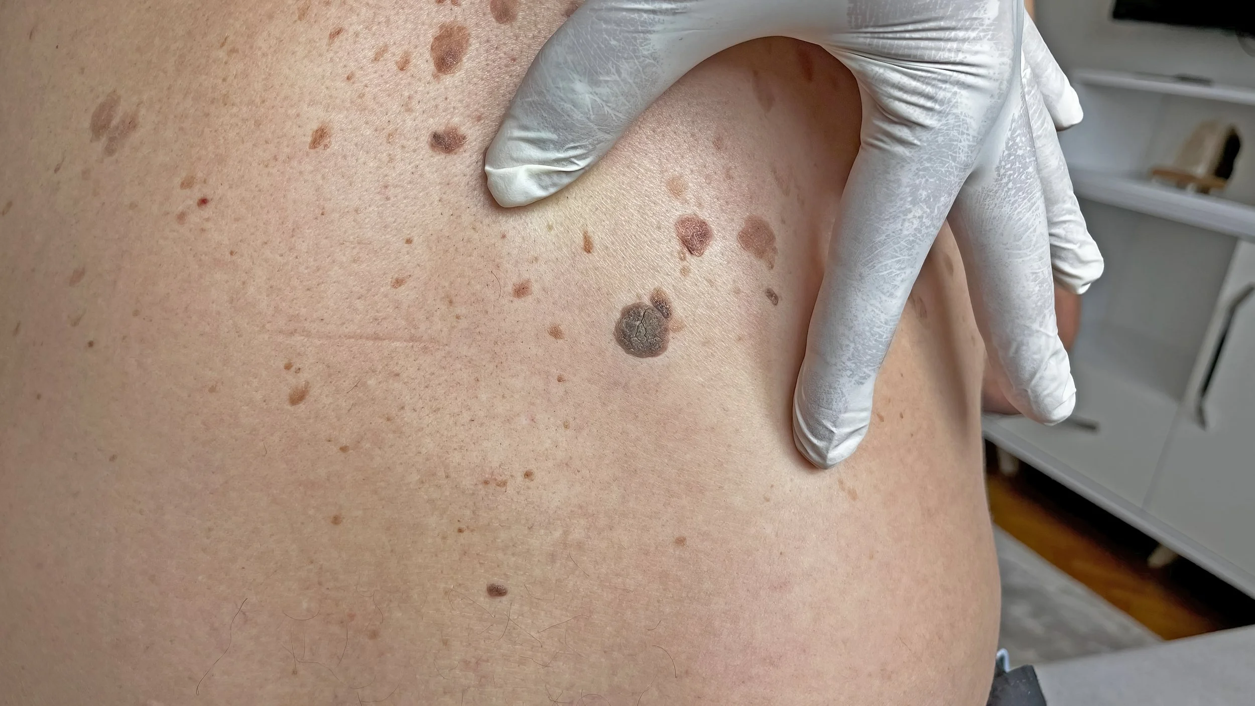 Seborrheic keratosis removal Colorado Springs