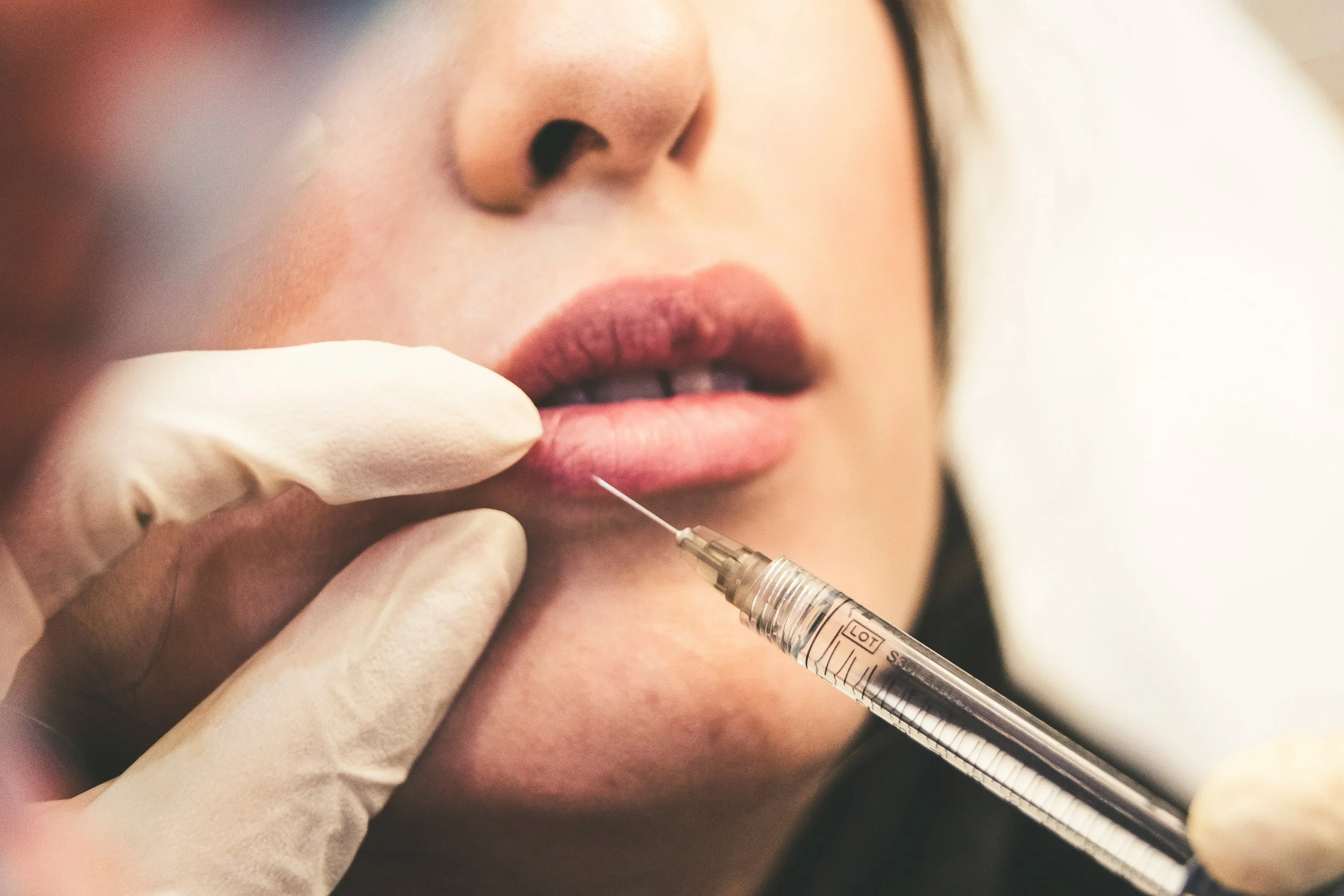 Close-up of a woman patient receiving a cosmetic injection near her lips, with a dermatologist wearing gloves holding the dermal filler syringe.