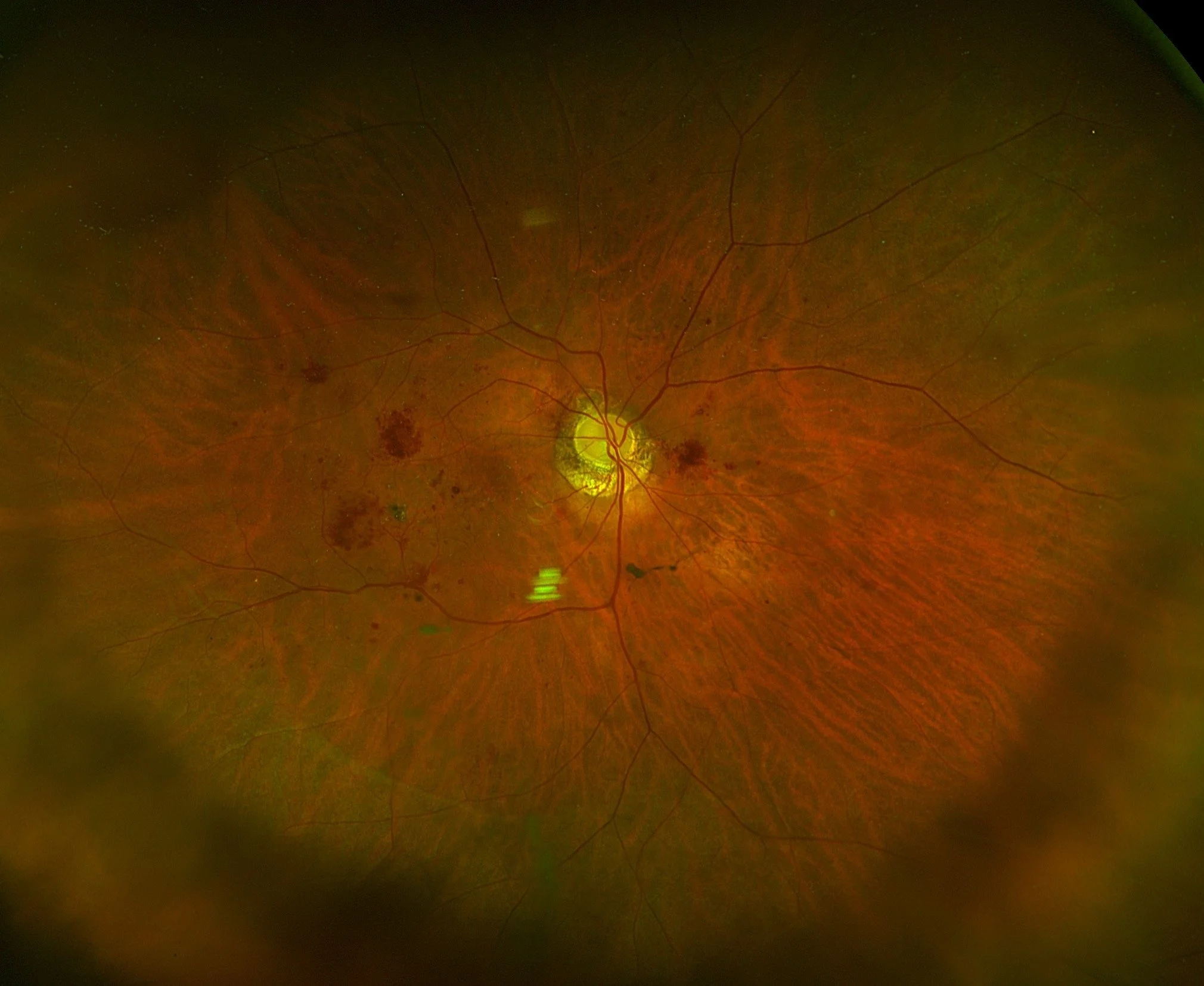 Ultra-widefield retinal photograph of the right eye showing the optic nerve, macula and peripheral retina