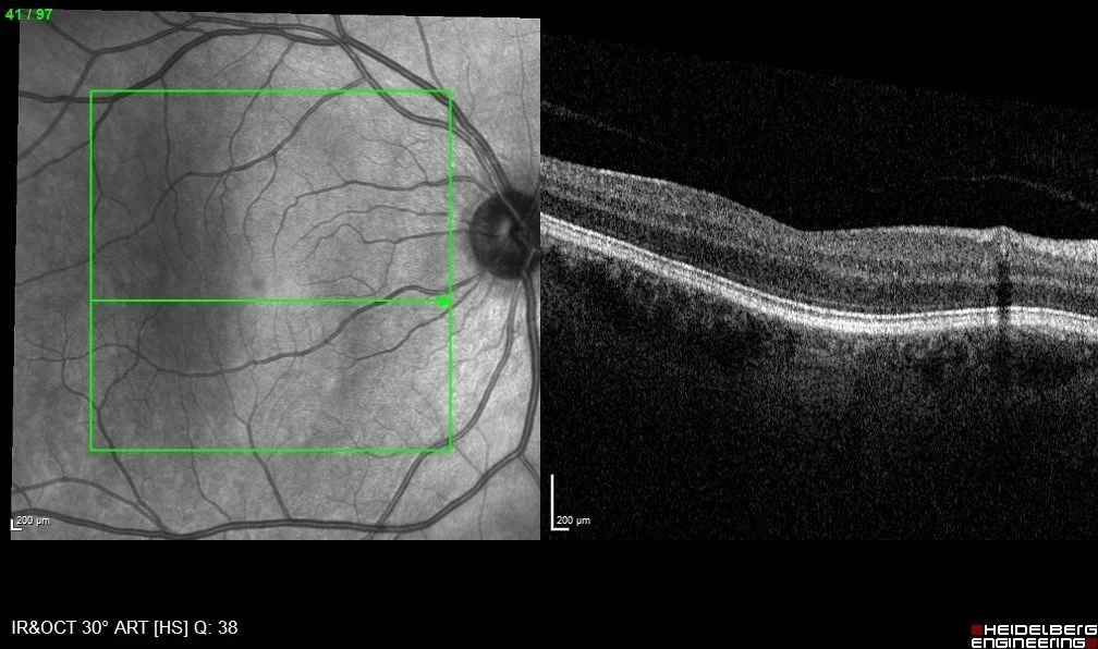 OCT macular scan alongside its infrared reference image, showing the layers of the central retina in cross section