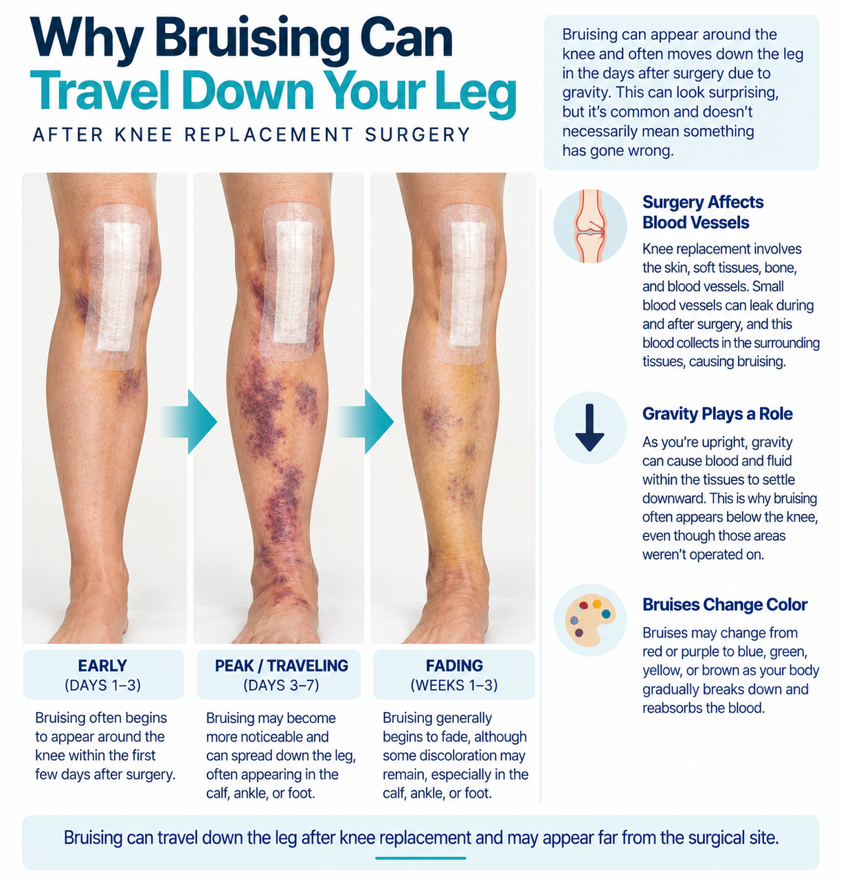 Illustration showing why bruising can travel down the leg after knee replacement surgery