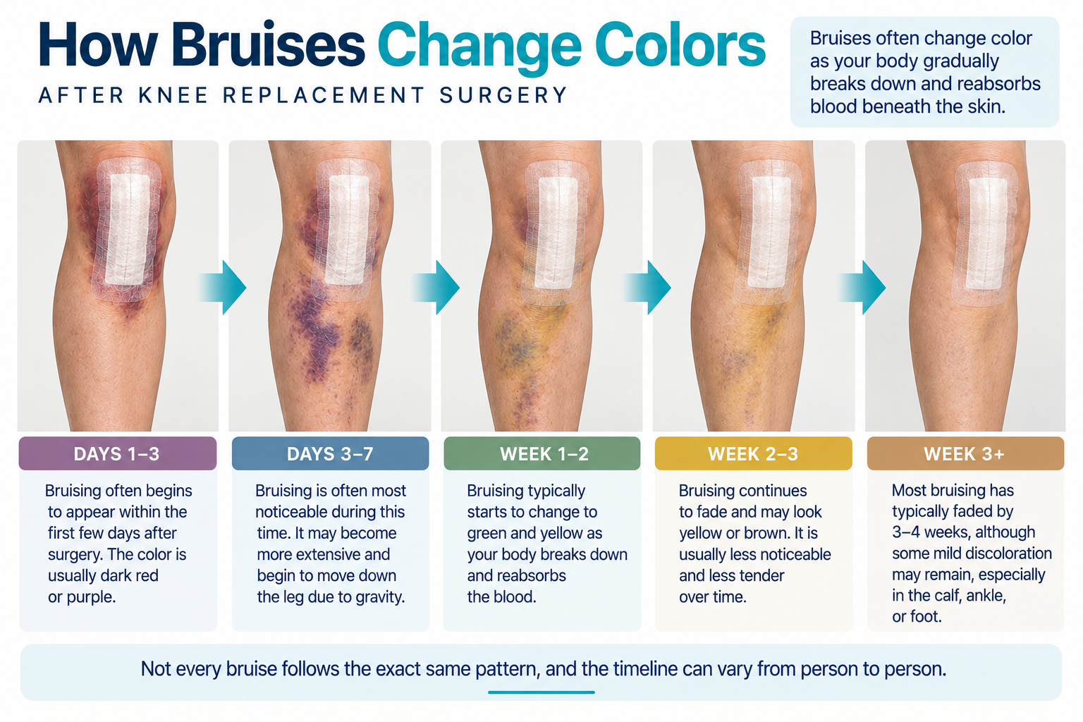 Timeline showing how bruising can change color during recovery after knee replacement surgery