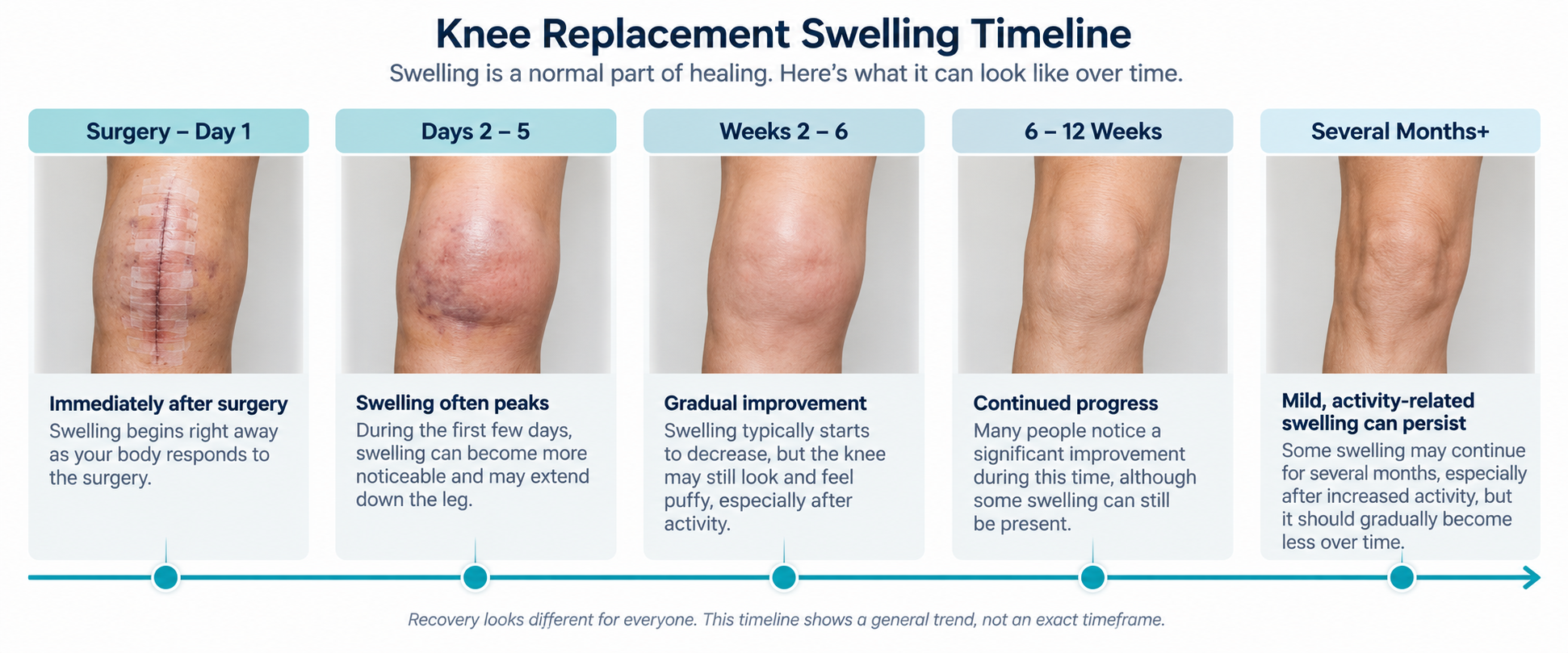 Knee replacement swelling timeline showing how swelling typically changes from surgery through several months of recovery
