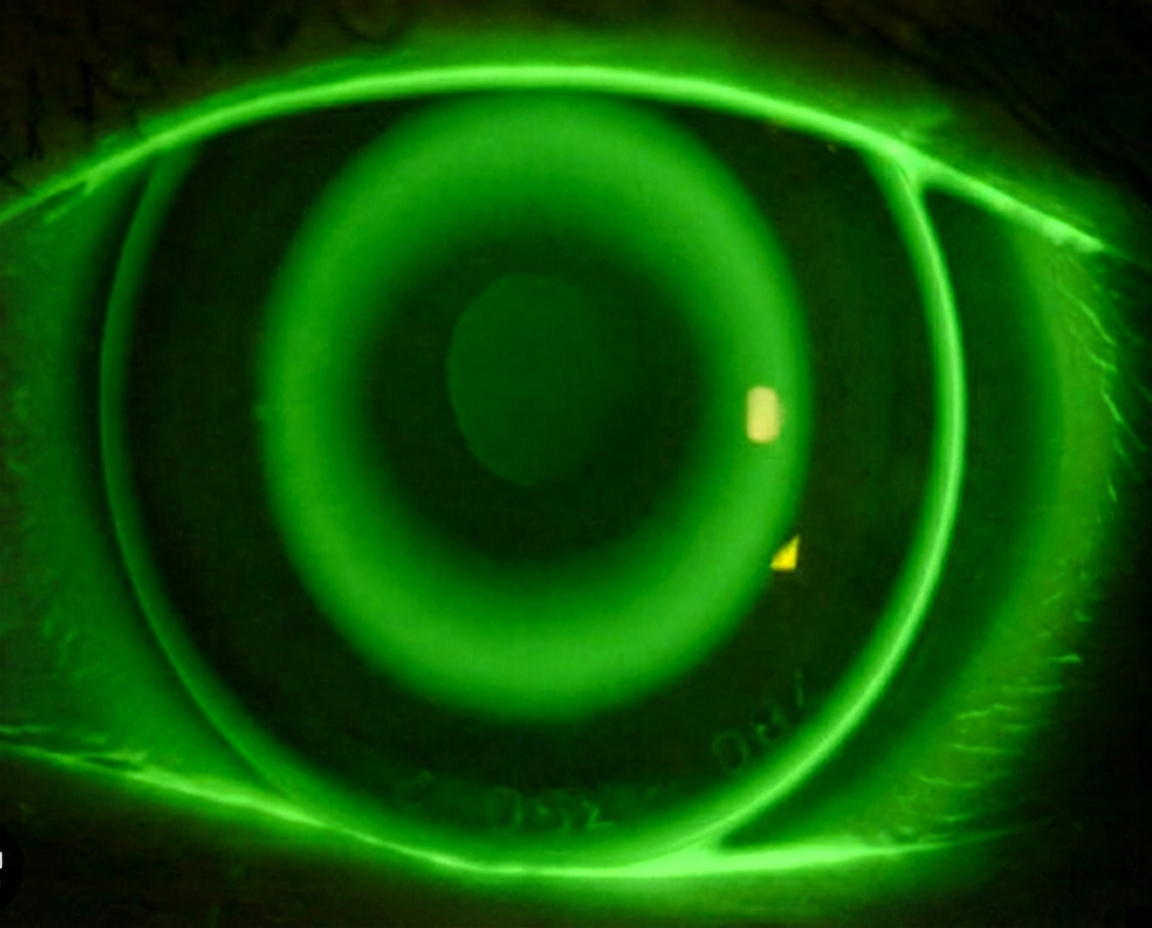 Image of Orthokeratology lens fit on cornea under bluer light and fluorescein dye