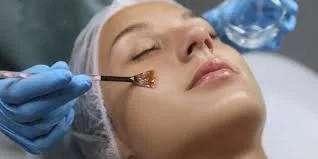 BioRePeel chemical peel improving acne, pigmentation and skin texture.