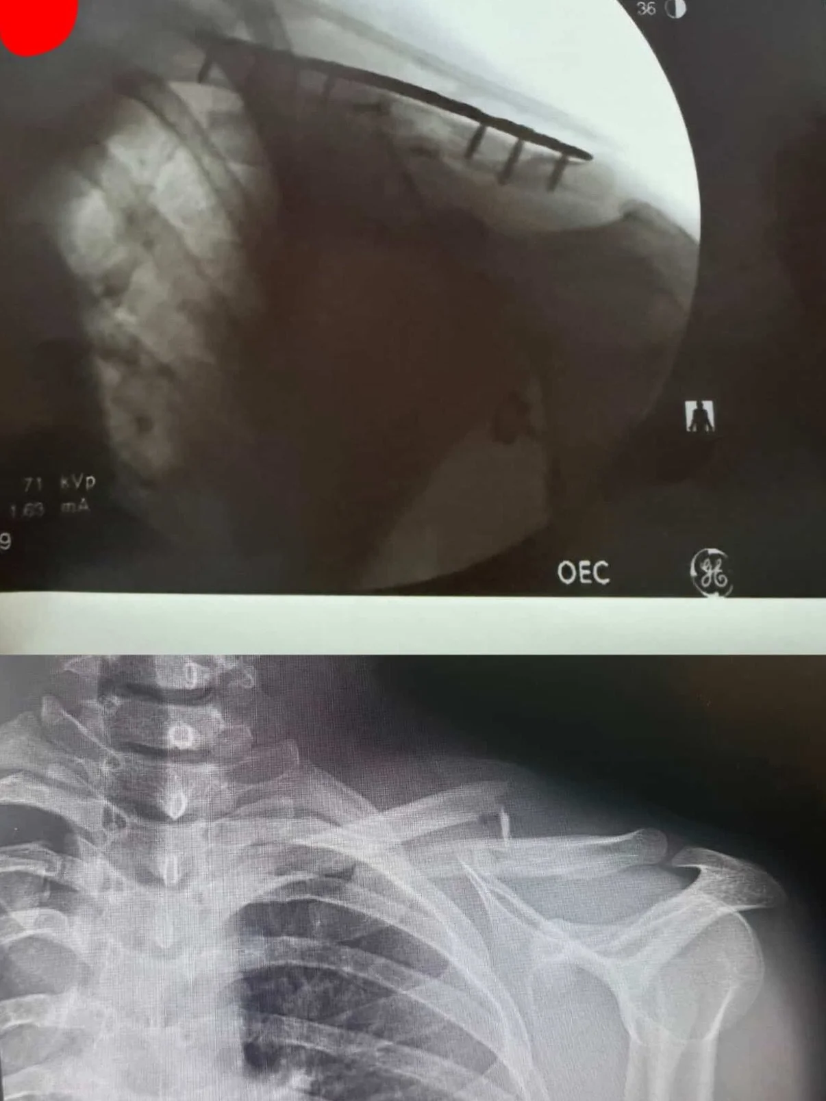 Quite a tough week for shoulders, gear, and snow!!!

Our winner this week is @sashadumee for these gorgeous x-rays. We will be sure to pick a beanie that goes well with the pins. Stay safe on the slopes y&rsquo;all, lots of low coverage (unfortunatel
