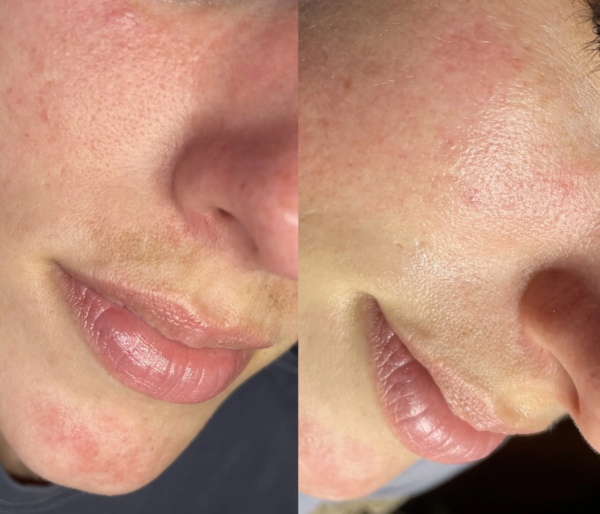 Close-up of a person's nose, cheeks, and lips showing skin texture and pores in detail.