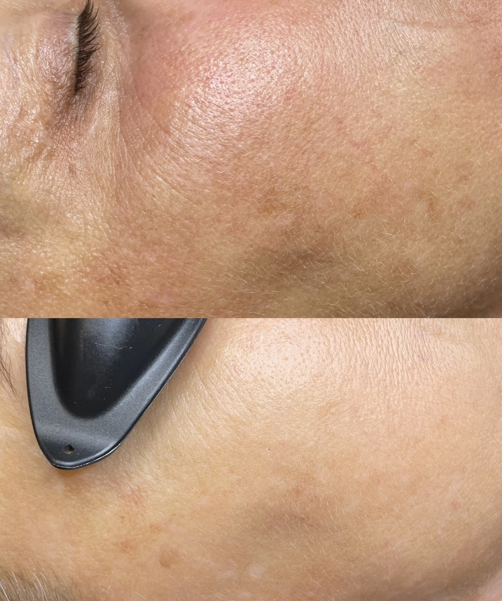 Close-up of a person's skin showing a before and after comparison of skin tightening or smoothing treatment, with the second image featuring a black dermatological tool on the skin.