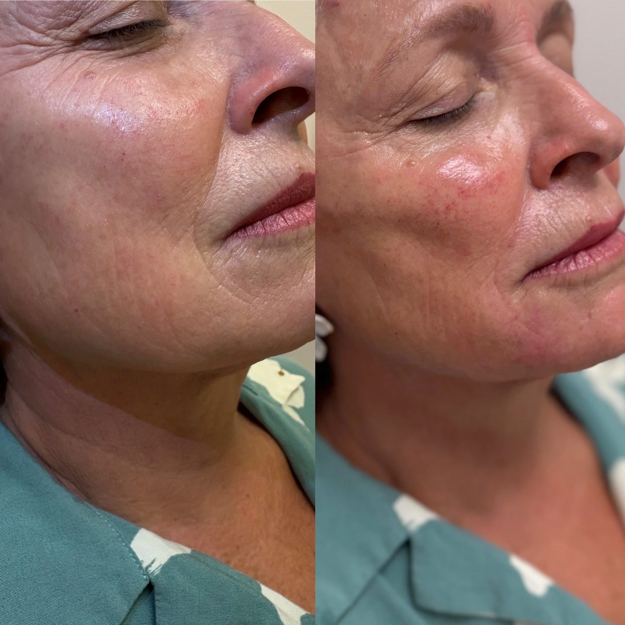 Close-up of a woman's face showing before and after skincare treatment, highlighting improved skin texture and reduced redness.