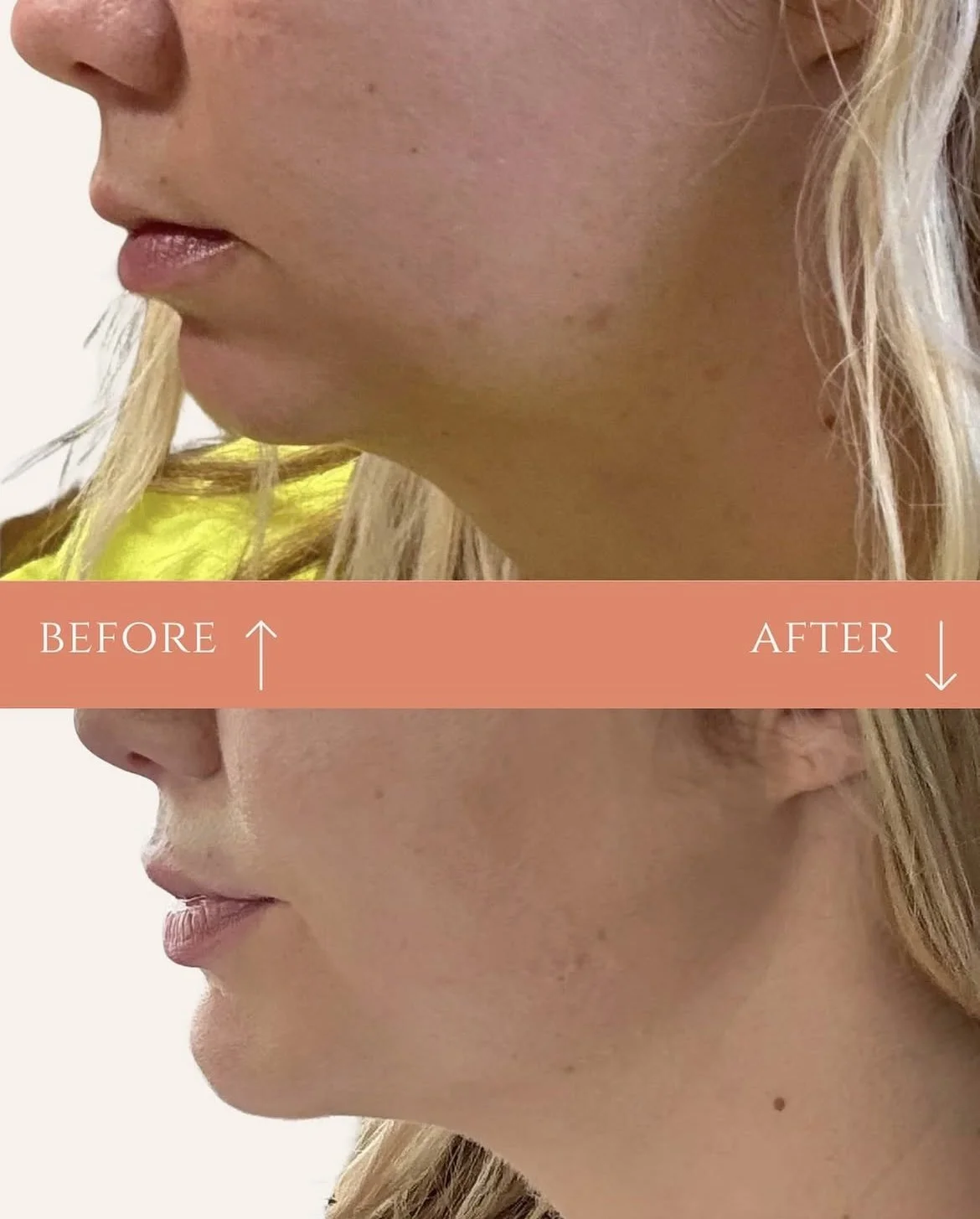 Side-by-side comparison of a woman's face, showing a before-and-after transformation of her skin with text labels and arrows indicating 'Before' and 'After'.