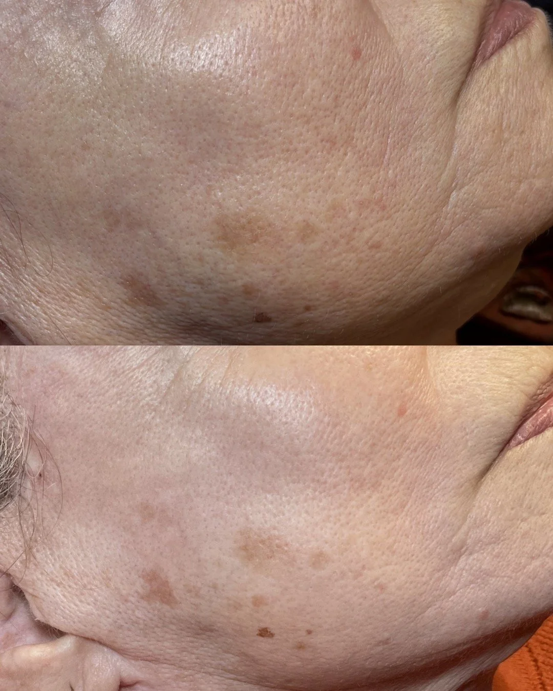 Close-up of a person's cheek showing skin before and after treatment for hyperpigmentation and uneven skin tone. The top image shows darker pigmentation, and the bottom image shows clearer, more even skin.