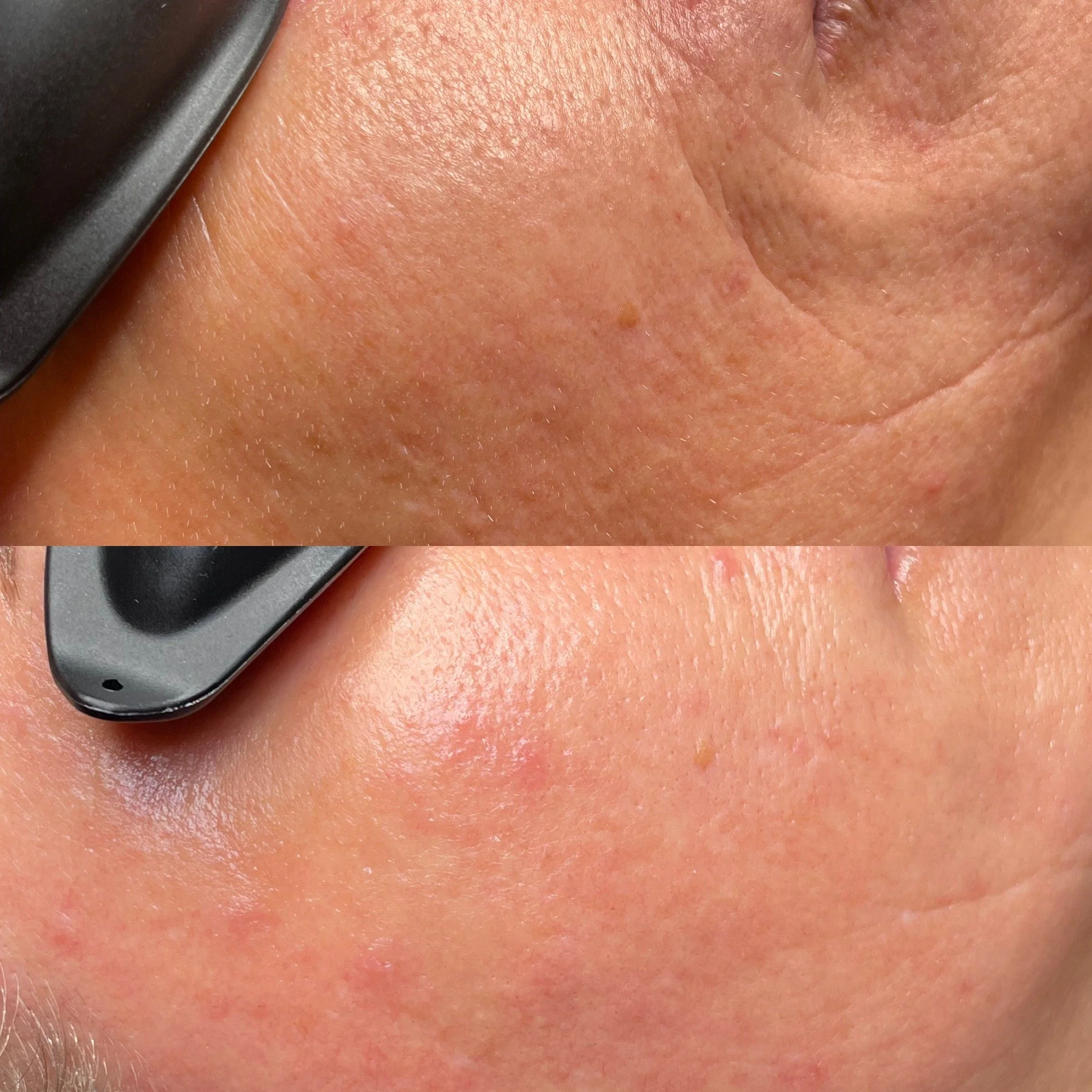 A side-by-side comparison of close-up skin before and after treatment showing improvement in skin texture and appearance, with a black scalpel as a reference point.