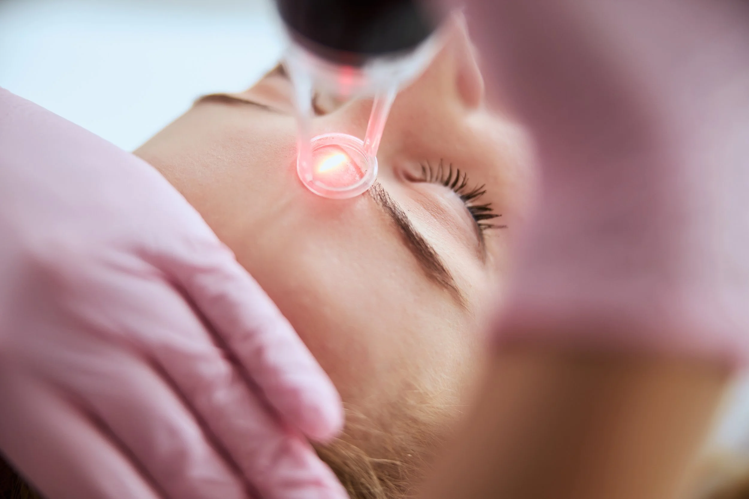 A person receiving a facial treatment with a laser device on their face, lying down with their eyes closed.