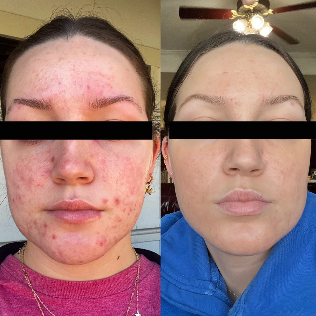 Comparison of a woman’s face before and after treatment for acne, showing significant reduction in redness and acne lesions.
