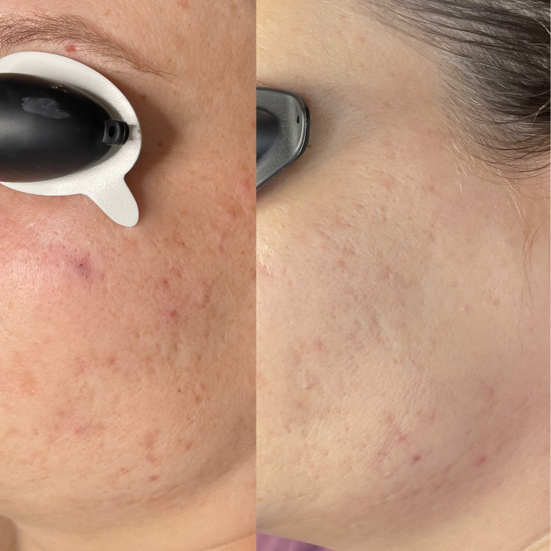 A side-by-side comparison of skin before and after skincare treatment, showing reduced redness and improved skin texture.