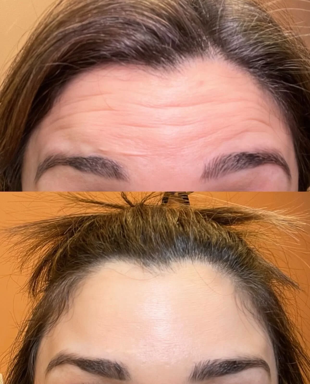 Comparison of a woman's forehead and eyebrows before and after cosmetic treatment, showing reduced wrinkles and smoother skin in the after photo.
