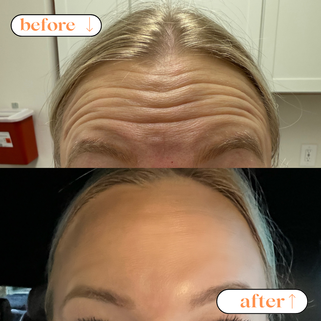 A comparison of a person's forehead before and after a treatment or cosmetic procedure. The "before" image shows prominent horizontal wrinkles, while the "after" image shows a smooth, wrinkle-free forehead.