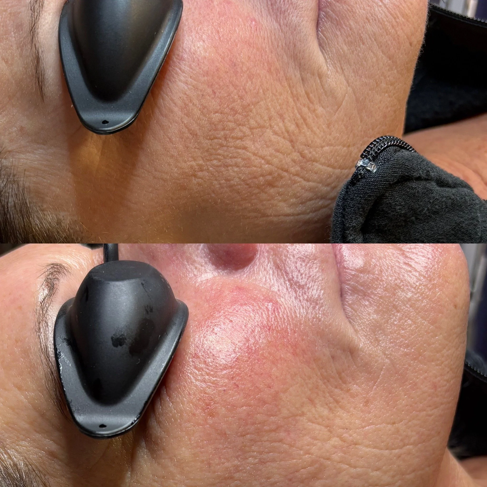 Comparison of skin before and after treatment showing reduced wrinkles and smoother texture around the nose.