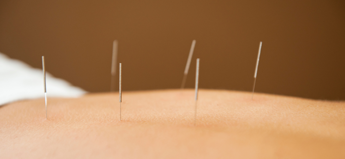 Acupuncture for Pain-Fatigue-Sleep Cluster in Breast Cancer Survivors: A Randomized Trial on Mechanisms and Efficacy