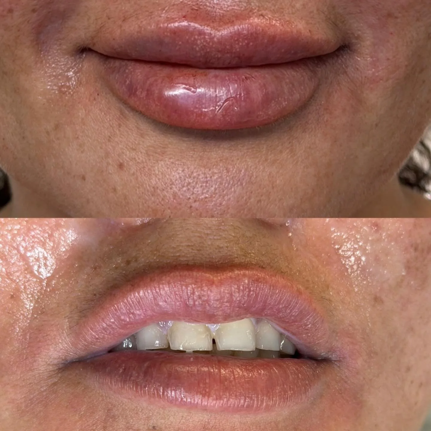 Beautiful transformation today. smile lines and Challenging shape and asymmetry corrected with 0.6 ml @revanesse