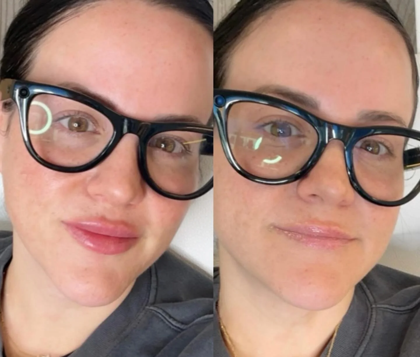 Enhance, not change &mdash; just beautifully balanced lips for our beautiful patient 💕