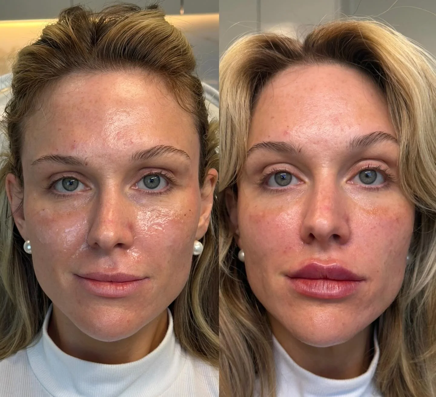 We are always deeply grateful to patients who are willing to share their journey. Thoughtful facial balancing was performed to support improved symmetry and soft, natural results.
✨ Temples &bull; Mid-face &bull; Piriform &bull; Lips ✨