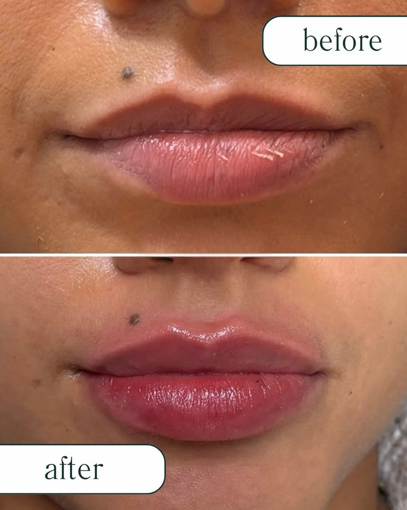 Just trust 👄✨💕 #lipfiller #lips #liplove #aestheticinjector #aesthetic