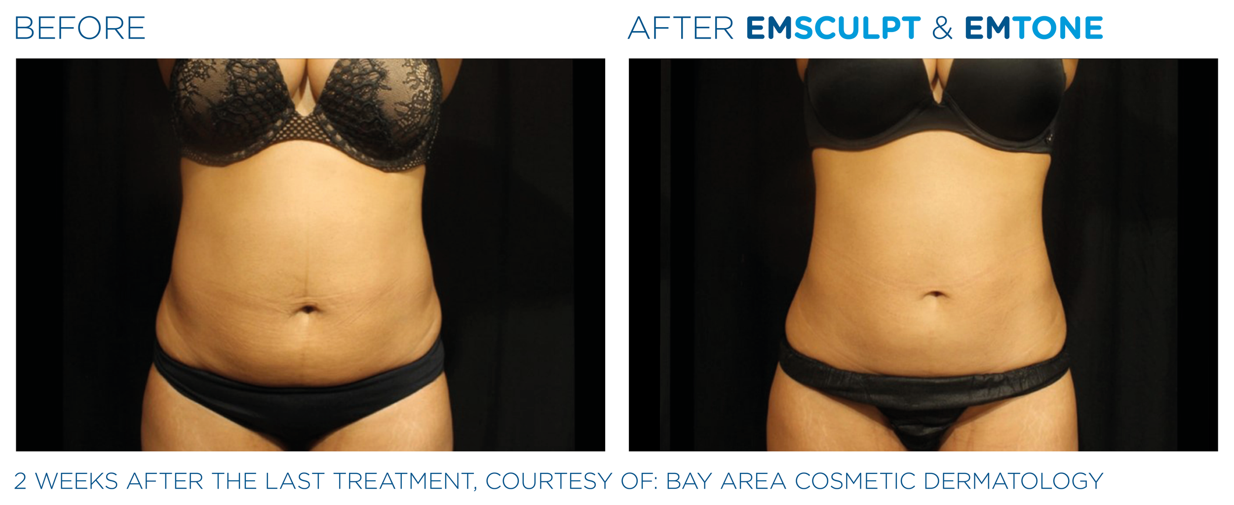 Emsculpt_Emtone_PIC_Ba-card-female-abdomen-002_EN100.png