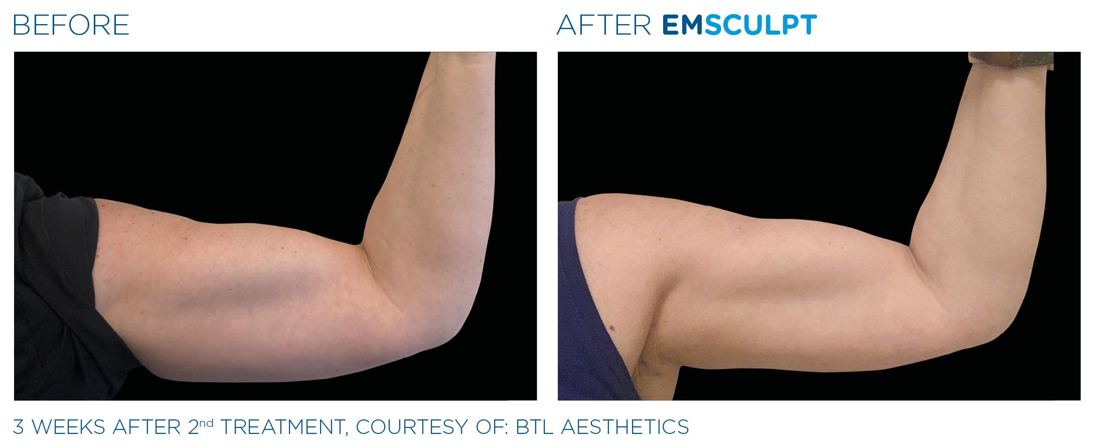 Emsculpt_PIC_Ba-card-female-arms-113_ENUS100.png