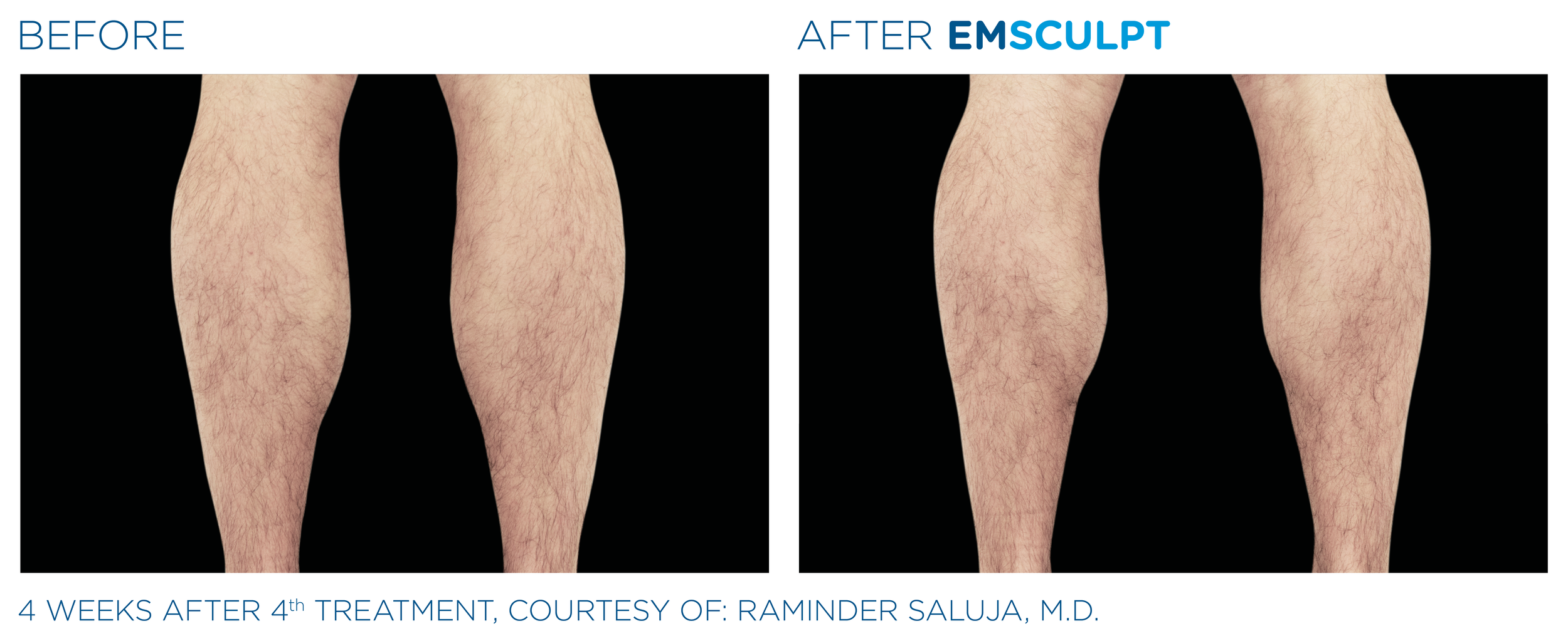 Emsculpt_PIC_Ba-card-male-legs-083_EN100.png