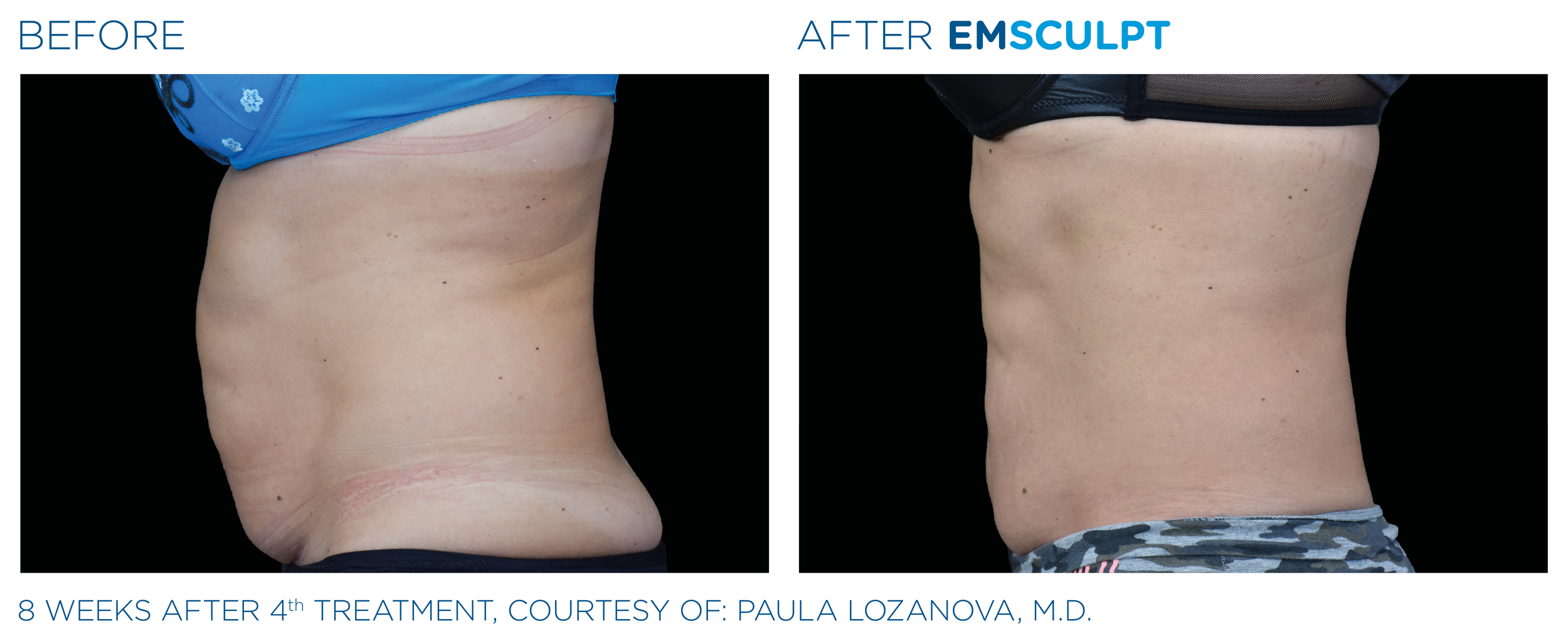 Emsculpt_PIC_Ba-card-female-abdomen-022_EN100.png