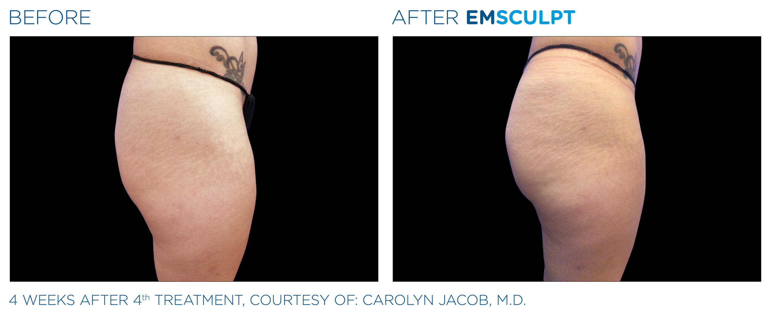 Emsculpt_PIC_Ba-card-female-buttock-017_EN100.png