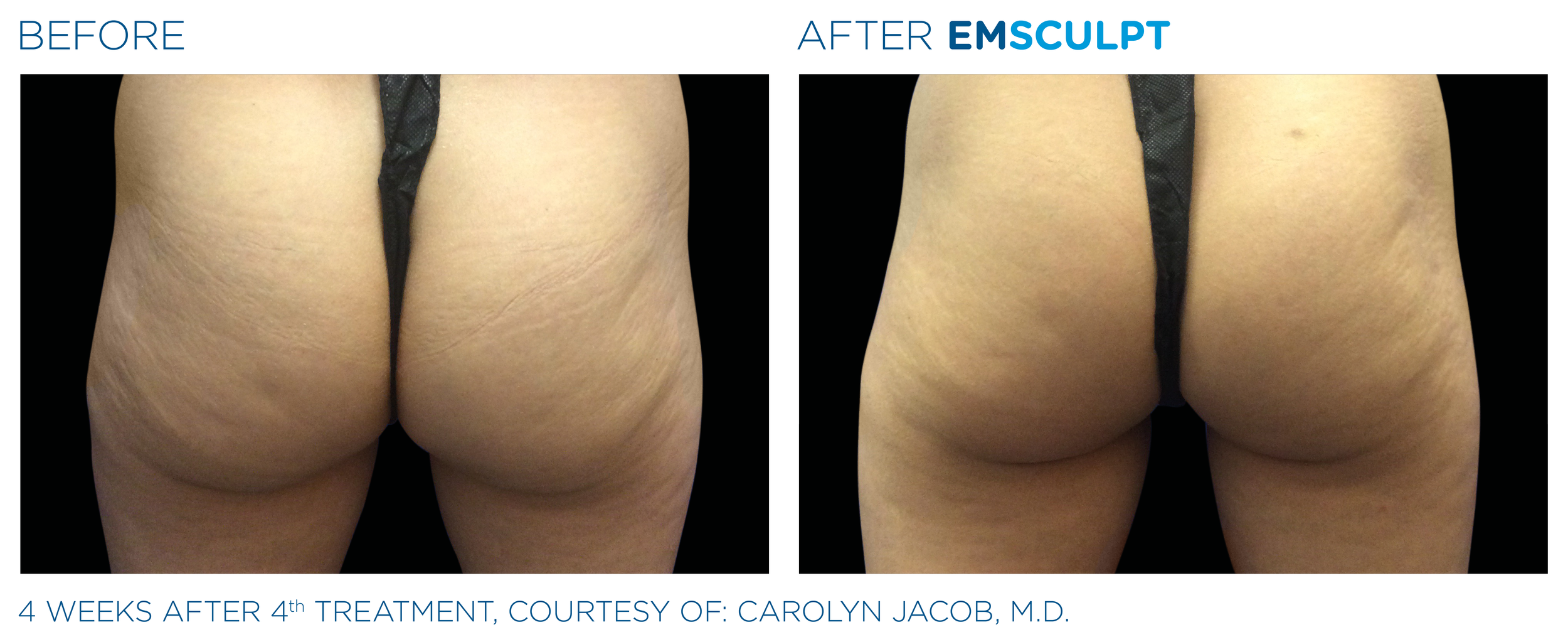Emsculpt_PIC_Ba-card-female-buttock-005_EN100.png