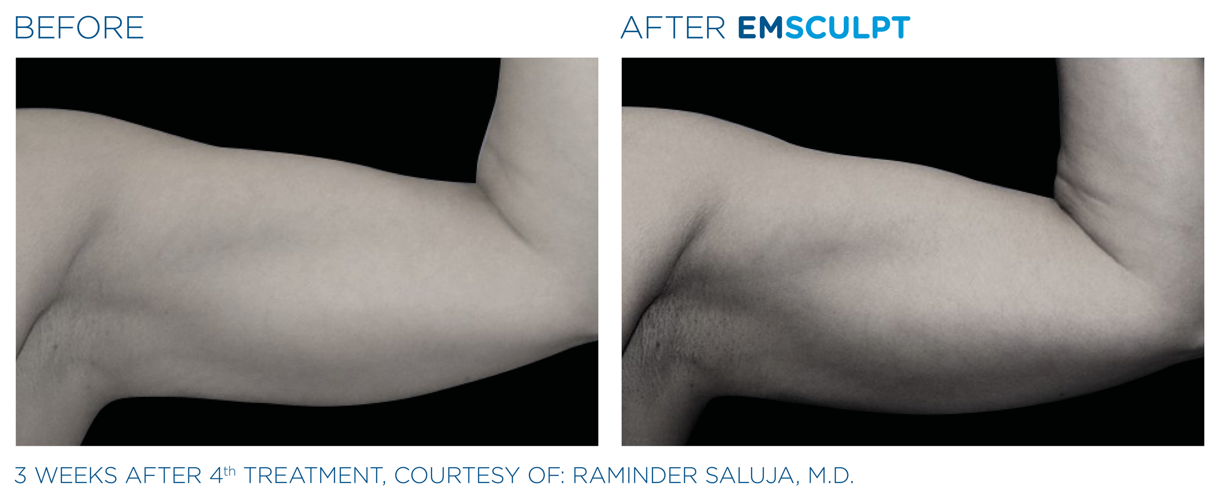 Emsculpt_PIC_Ba-card-female-arms-076_EN100.png